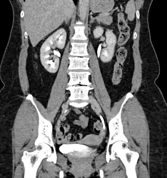 Normal CT intravenous urogram (Radiopaedia 39444-41759 A 288).jpg