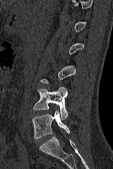 File:Normal CT lumbar spine (Radiopaedia 53981-60118 Sagittal bone window 32).jpg