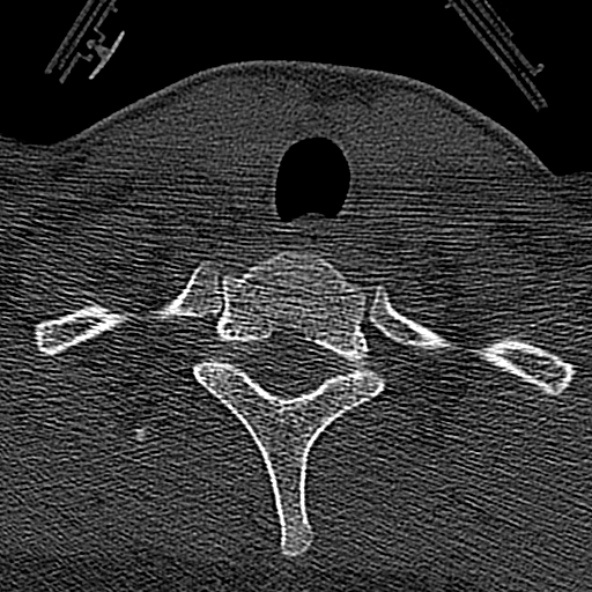 File:Normal CT of the cervical spine (Radiopaedia 53322-59305 Axial bone window 234).jpg