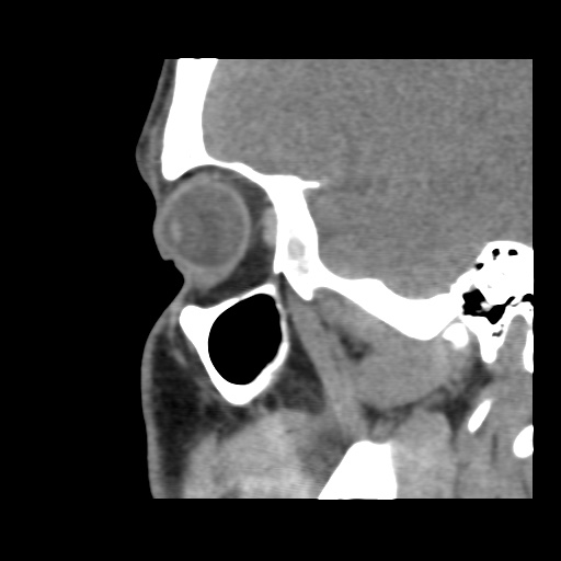 Normal CT paranasal sinuses (Radiopaedia 42286-45390 F 42).jpg