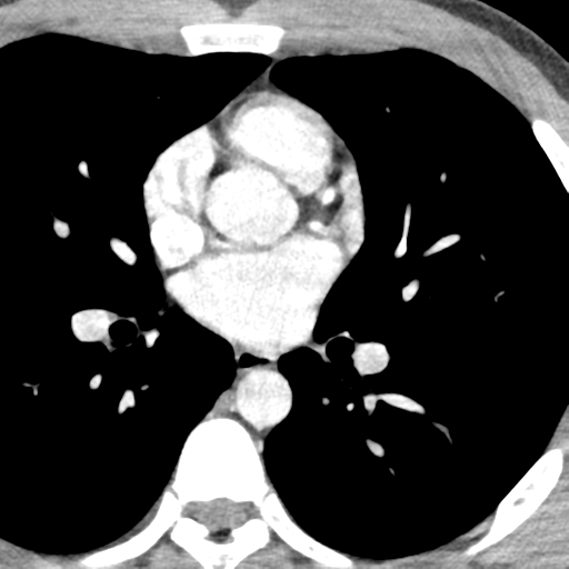 File:Normal CT pulmonary veins (pre RF ablation) (Radiopaedia 41748-44702 A 135).png