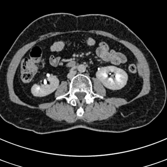 File:Normal CT split bolus study of the renal tract (Radiopaedia 48631-53634 Axial split bolus 125).jpg