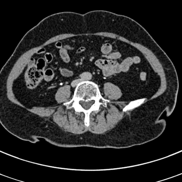 File:Normal CT split bolus study of the renal tract (Radiopaedia 48631-53634 Axial split bolus 164).jpg