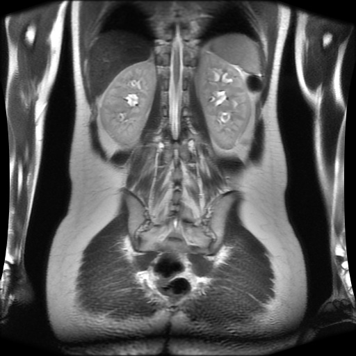 File:Normal MRI abdomen in pregnancy (Radiopaedia 88001-104541 Coronal T2 25).jpg
