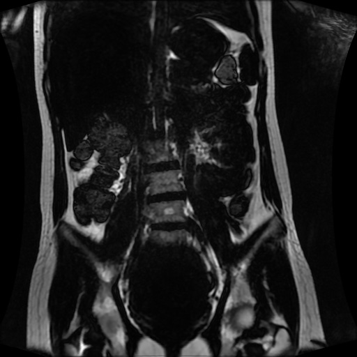 Normal MRI abdomen in pregnancy (Radiopaedia 88001-104541 N 79).jpg