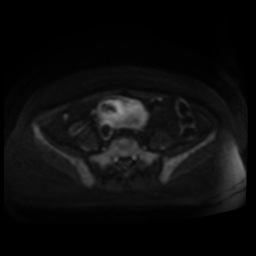 Normal MRI abdomen in pregnancy (Radiopaedia 88005-104548 Axial DWI 101).jpg