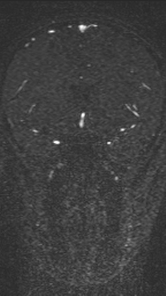 Normal MRI brain with MRV- teenager (Radiopaedia 49425-54553 Coronal MRV 101).jpg
