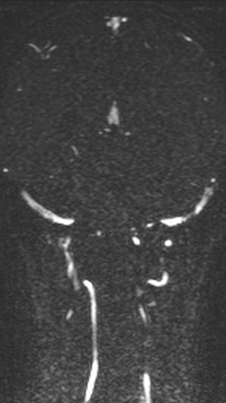 Normal MRI brain with MRV- teenager (Radiopaedia 49425-54553 Coronal MRV 162).jpg