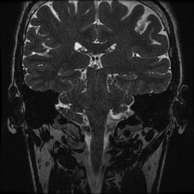 Normal MRI petrous (Radiopaedia 91317-108949 Coronal T2 70).jpg
