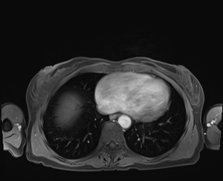 Normal adrenal glands MRI (Radiopaedia 82017-96004 M 2).jpg