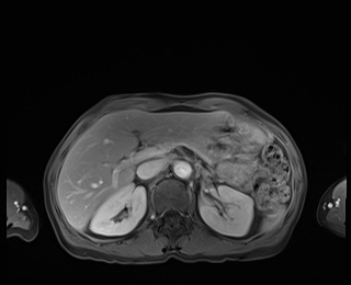 Normal adrenal glands MRI (Radiopaedia 82017-96004 M 30).jpg