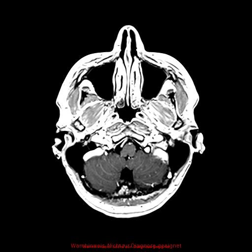 Normal adult brain MRI (non-enhanced and contrast-enhanced) (Radiopaedia 75262-86379 Axial T1 C+ 50).jpg