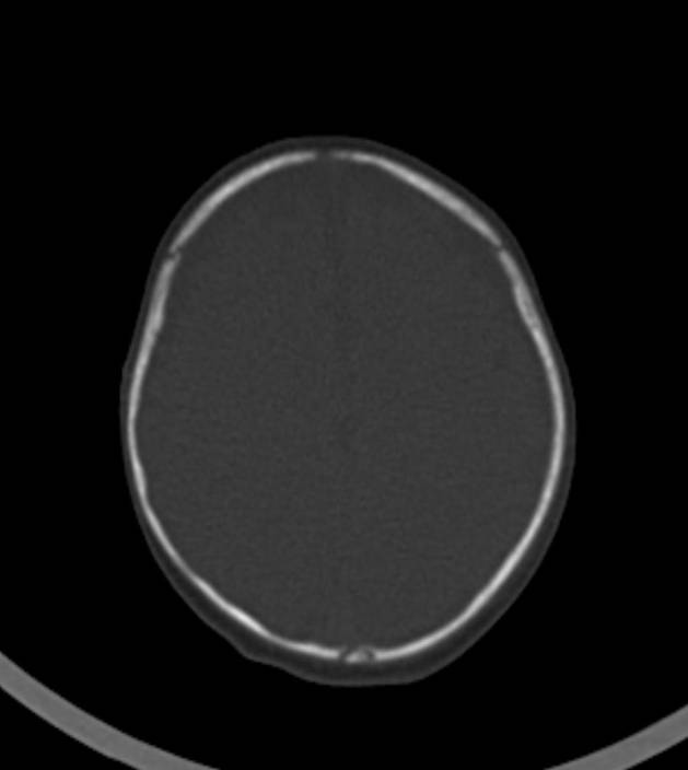 Normal brain CT - 2-month-old (Radiopaedia 53369-59350 Axial bone window 14).jpg