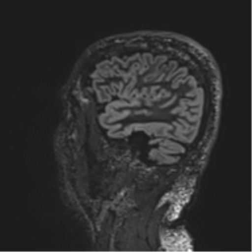 Normal brain MRI (non-focal epilepsy protocol) (Radiopaedia 53917-60040 Sagittal DIR 50).png