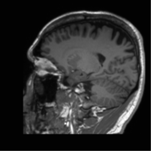 Normal brain MRI (non-focal epilepsy protocol) (Radiopaedia 53917-60040 Sagittal T1 23).png