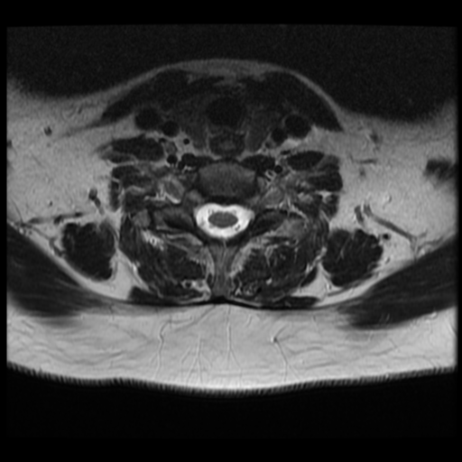 File:Normal cervical and thoracic spine MRI (Radiopaedia 35630-37156 Axial T2 10).png