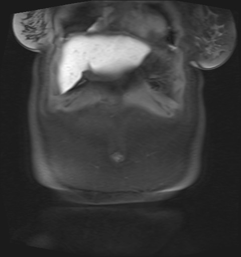 File:Normal hepatobiliary phase liver MRI (Radiopaedia 58968-66230 B 47).jpg