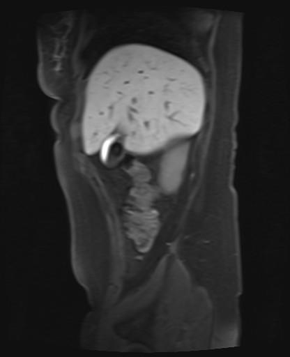 File:Normal hepatobiliary phase liver MRI (Radiopaedia 58968-66230 C 16).jpg
