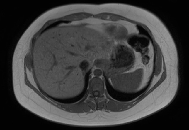 File:Normal liver MRI with Gadolinium (Radiopaedia 58913-66163 Axial T1 in-phase 26).jpg