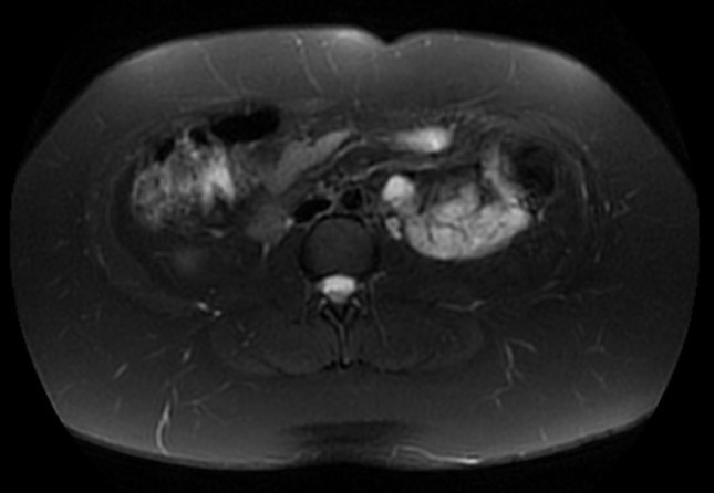 File:Normal liver MRI with Gadolinium (Radiopaedia 58913-66163 Axial T2 fat sat 10).jpg