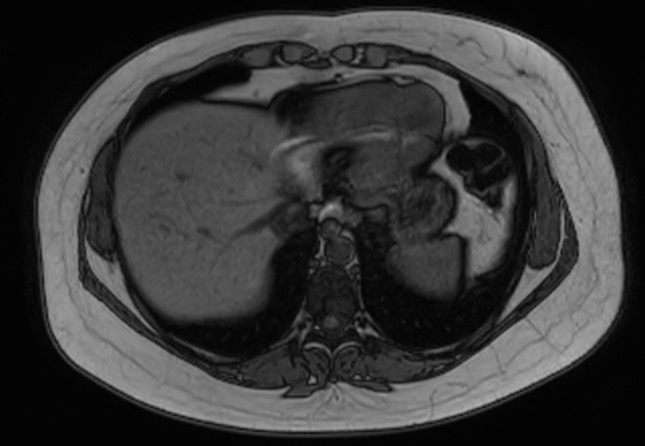 File:Normal liver MRI with Gadolinium (Radiopaedia 58913-66163 B 28).jpg
