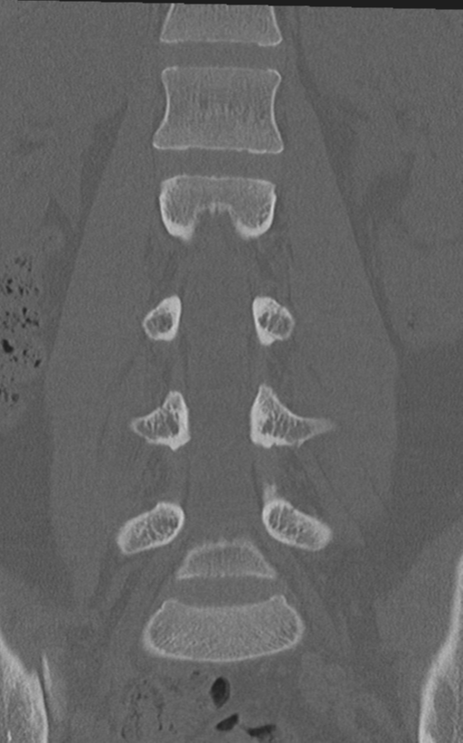 Normal lumbar spine CT (Radiopaedia 46533-50986 Coronal bone window 37).png