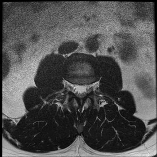 File:Normal lumbar spine MRI (Radiopaedia 35543-37039 Axial T2 29).png