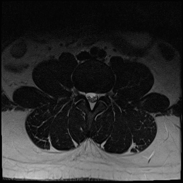 File:Normal lumbar spine MRI (Radiopaedia 47857-52609 Axial T2 8).jpg