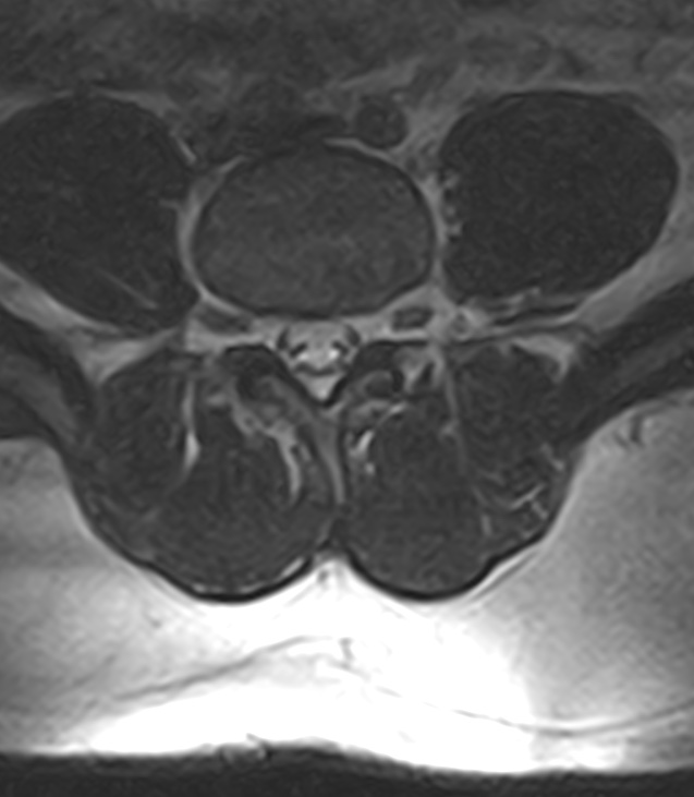 Normal lumbar spine MRI - low-field MRI scanner (Radiopaedia 40976-43699 Axial T2 72).jpg