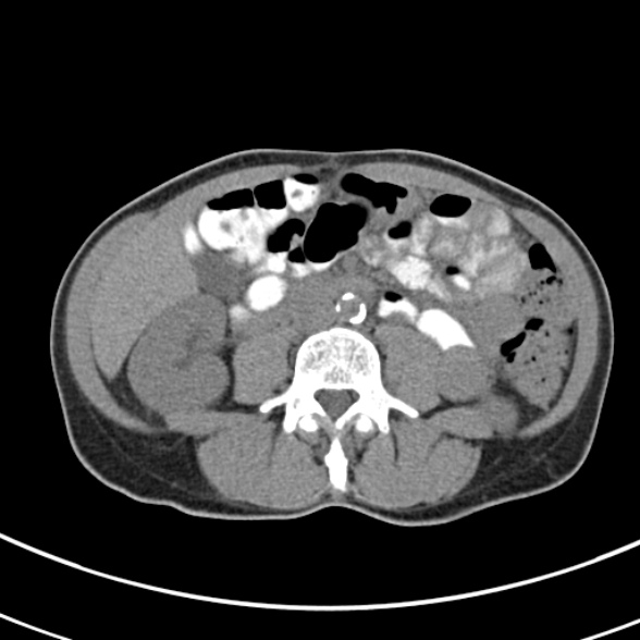 File:Normal multiphase CT liver (Radiopaedia 38026-39996 Axial non-contrast 44).jpg