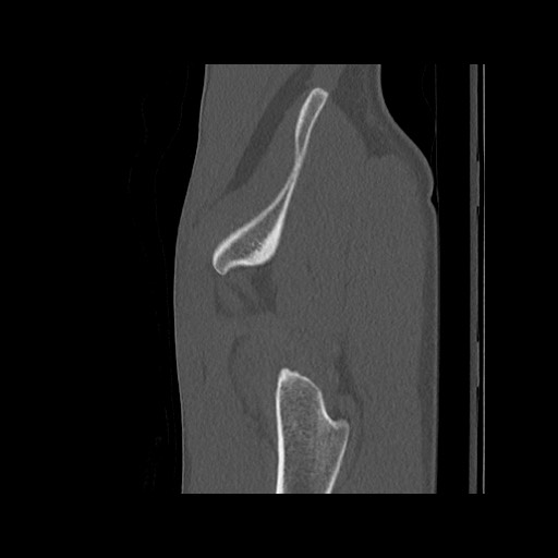 Normal pelvis (Radiopaedia 51473-57238 Sagittal bone window 127).jpg