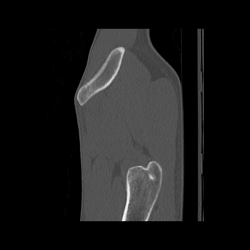 Normal pelvis (Radiopaedia 51473-57238 Sagittal bone window 16).jpg