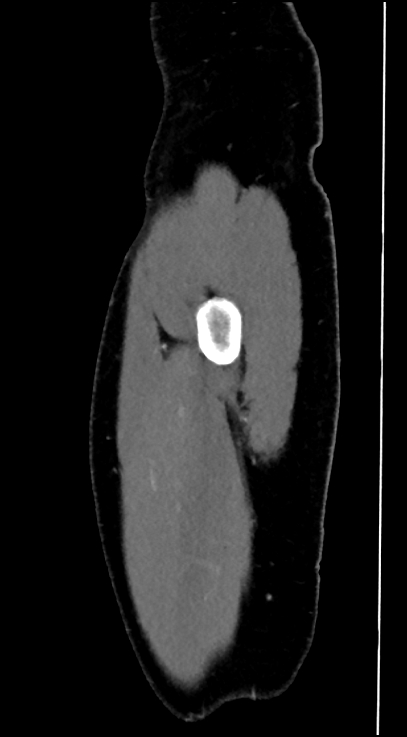 Normal pelvis CT angiogram (Radiopaedia 84966-100481 C 4).jpg
