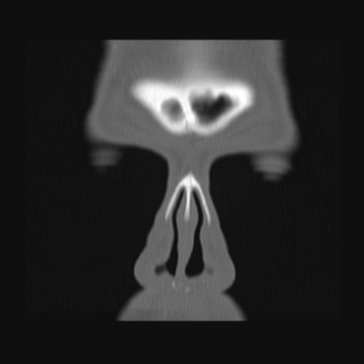 Normal sinus CT (annotated) (Radiopaedia 78917-91810 Coronal bone window 12).jpg