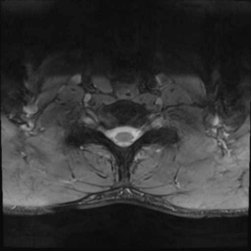File:Normal trauma cervical spine (Radiopaedia 41017-43762 Axial T2 25).png