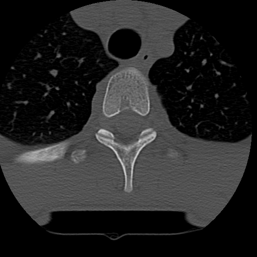 File:Normal trauma spine imaging (age 16) (Radiopaedia 45335-49358 Axial bone window 92).jpg