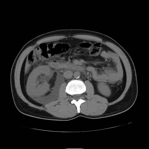 File:Obstructed kidney with perinephric urinoma (Radiopaedia 26889-27066 Axial non-contrast 24).jpg