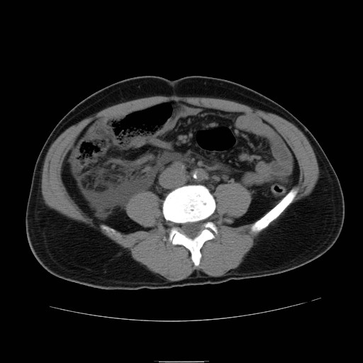 File:Obstructed kidney with perinephric urinoma (Radiopaedia 26889-27066 Axial non-contrast 38).jpg