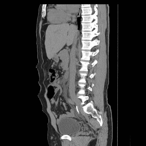 File:Obstructed kidney with perinephric urinoma (Radiopaedia 26889-27066 B 27).jpg