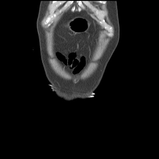 Obstructing renal calculus (Radiopaedia 29517-30016 Coronal non-contrast 4).jpg