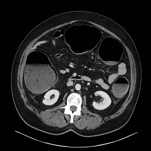 Obstructing sigmoid adenocarcinoma (Radiopaedia 58465-65619 A 74).jpg