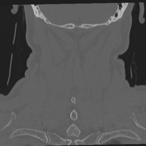 File:Occipital condyle fracture (Radiopaedia 33467-34517 Coronal bone window 56).png