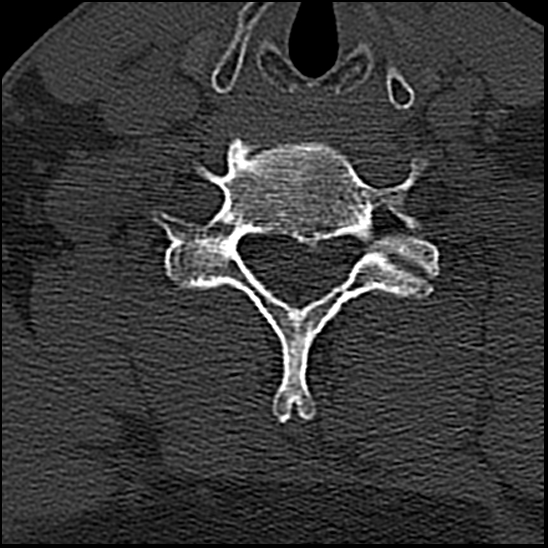 Occipital condyle fracture (type 1) (Radiopaedia 87670-104084 Axial bone window 66).jpg