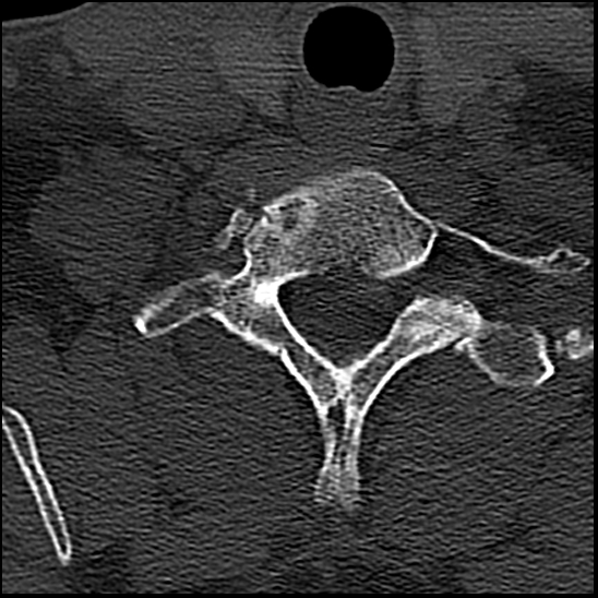 Occipital condyle fracture (type 1) (Radiopaedia 87670-104084 Axial bone window 76).jpg