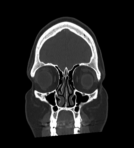 Occipital spur and Currarino type A atlas anomaly (Radiopaedia 87027-103285 Coronal bone window 38).jpg