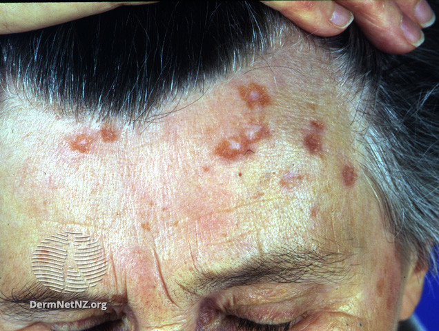 File:Sarcoid granulomas (DermNet NZ dermal-infiltrative-sarc-face).jpg