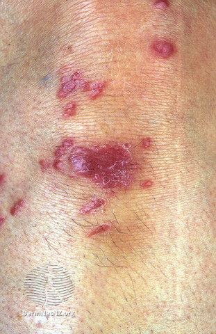 File:Sarcoid on knee (DermNet NZ dermal-infiltrative-sarc-scar).jpg