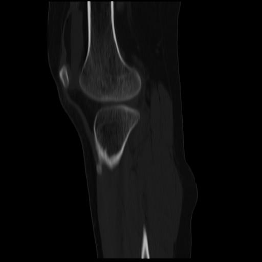 File:ACL avulsion fracture (Radiopaedia 33833-34994 Sagittal bone window 15).jpg