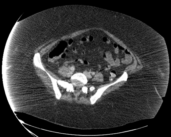 File:Abdominal abscess - pre and post percutaneous drainage (Radiopaedia 60209-67816 Axial 68).png