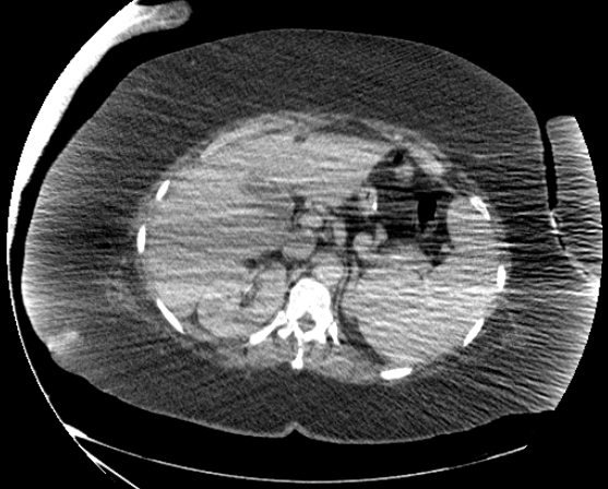 File:Abdominal abscess - pre and post percutaneous drainage (Radiopaedia 60209-67816 Axial 77).png